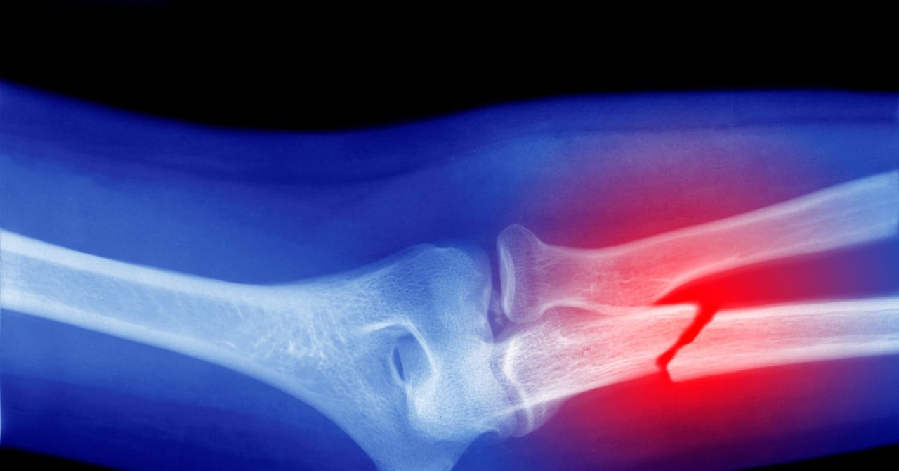 Investigación: Los microplásticos podrían debilitar tus huesos